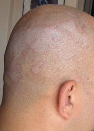 Seborrhoeic dermatitis example.jpg