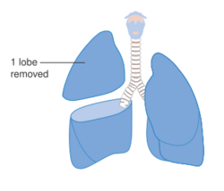 Diagram showing the removal of one lobe of the lung (lobectomy) CRUK 366.svg
