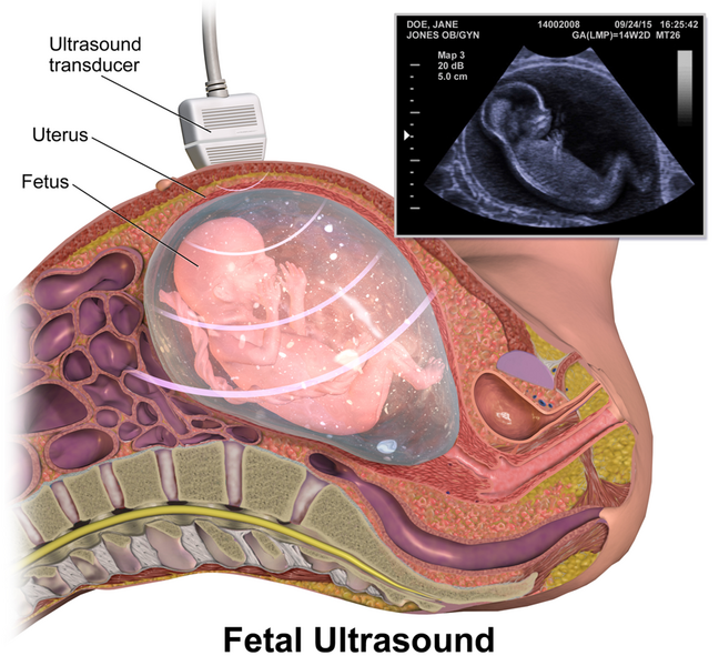 File:Fetal Ultrasound.png