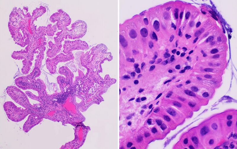 File:Histopathology of a hyperplastic polyp of the gallbladder.jpg