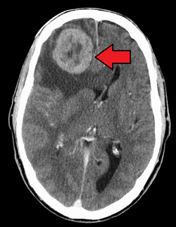 MetstoBrain(LungPri)Mark.png