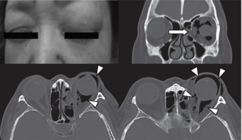 Orbital emphysema.png