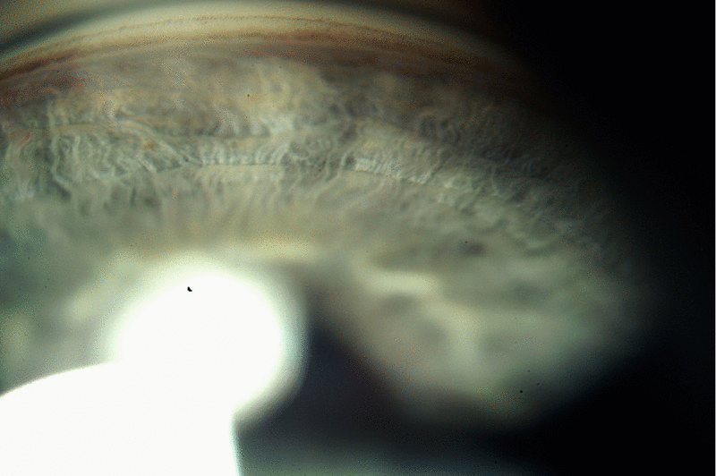 File:Anterior chamber angle - 3D motion parallax.gif