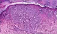 Histopathology of invasive acral lentiginous melanoma.jpg