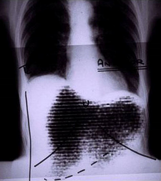 Rectilinear scan and chest X-ray fusion.png