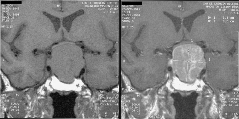 File:Acromegaly pituitary macroadenoma.JPEG