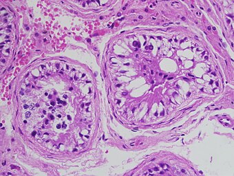 Germ cell aplasia with focal maturation arrest.jpg