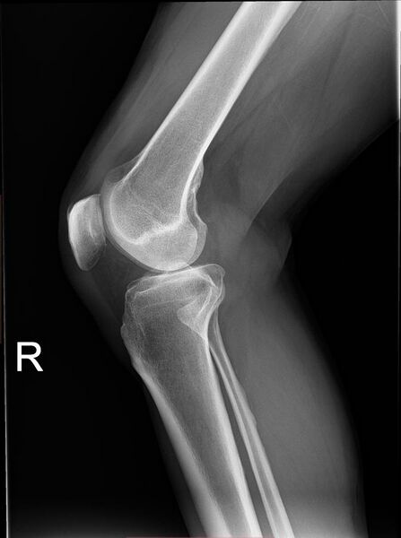 File:Knee plain X-ray.jpg