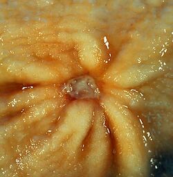 Benign gastric ulcer 1.jpg