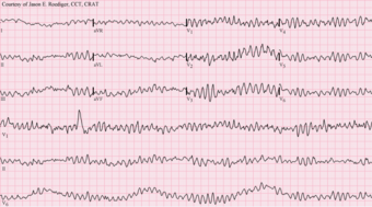Electrocardiographic image depicting Ventricular fibrillation