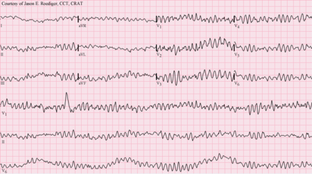 Medicine:Primary ventricular fibrillation - HandWiki