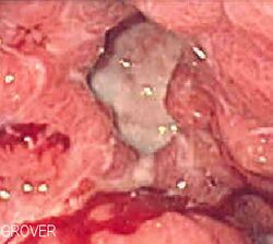 Gastric ulcer 3.jpg