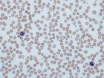 Iron deficiency anemia blood film.jpg