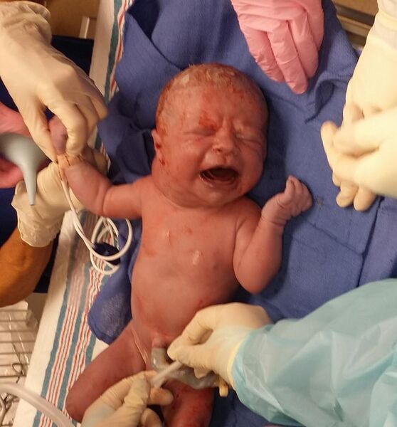 File:Newborn infant with a cystic hygroma (cropped).jpg