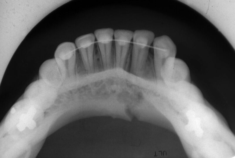 File:Occlusal view symphsis fracture.jpg