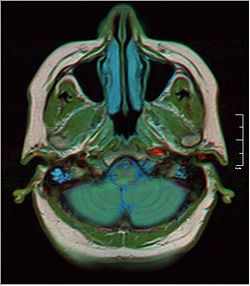 Brain MRI 0106 17.jpg