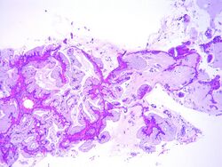 Bronchioloalveolar carcinoma, mucinous type 2.jpg