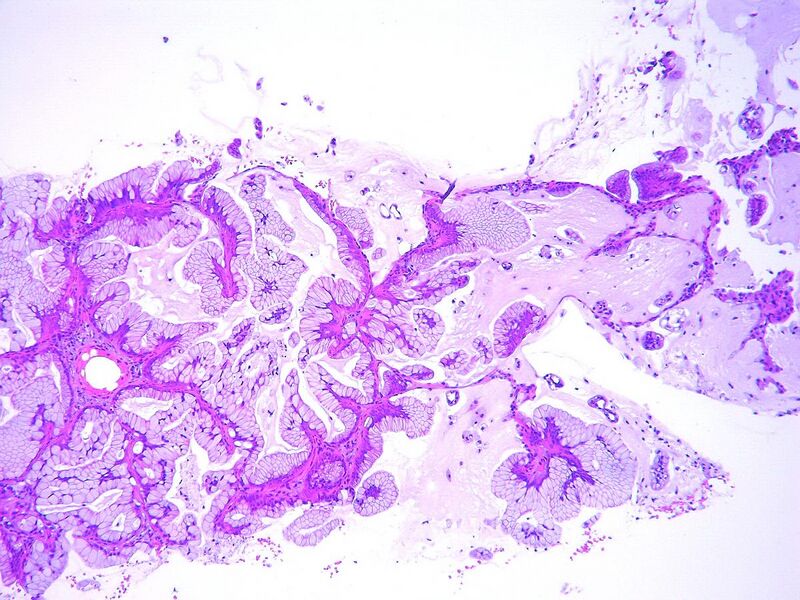 File:Bronchioloalveolar carcinoma, mucinous type 2.jpg