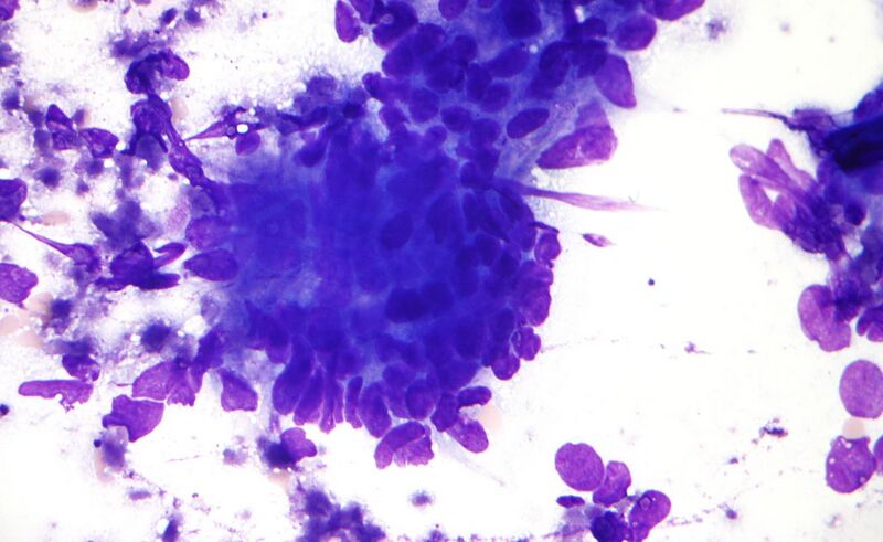 File:Colorectal adenocarcinoma cytology intermed mag.jpg