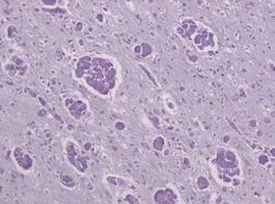 Globoid cell leukodystrophy PAS.jpg