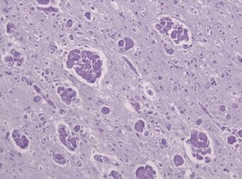 Globoid cell leukodystrophy PAS.jpg