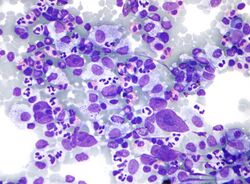 Hodgkin lymphoma cytology large.jpg