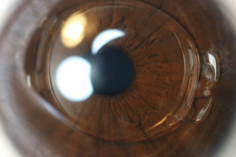 File:Intraocular lens under cornea, six years after installation (no flash).jpg