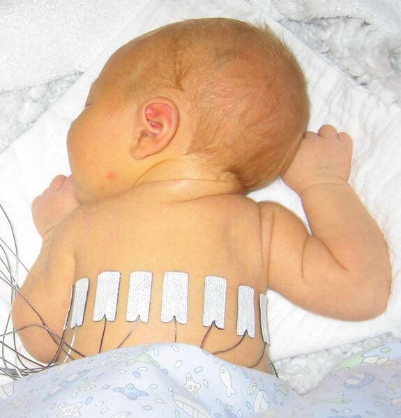 File:Neonate with electrical impedance tomography electrodes.jpeg