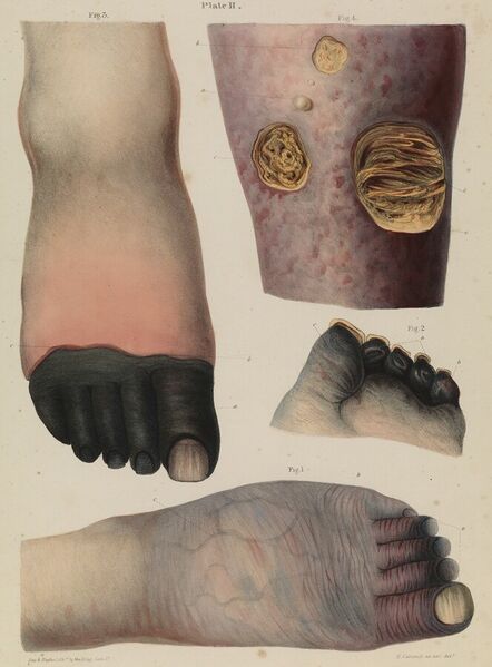 File:Plate II Mortification (gangrene), Robert Carswell 1830s Wellcome L0074380.jpg