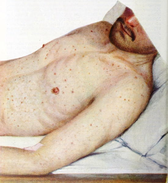 File:Epidemic Typhus. Macular rash 1.png