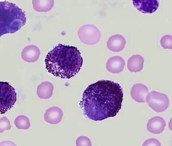 Mast cell leukemia.jpg