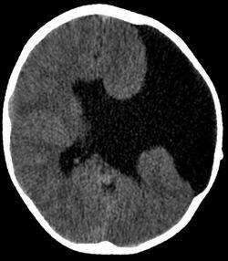 Schizenzephalie CT axial.jpg