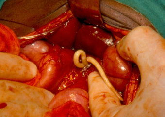 Adult ascaris worms being removed from the bile duct of a patient in South Africa.png