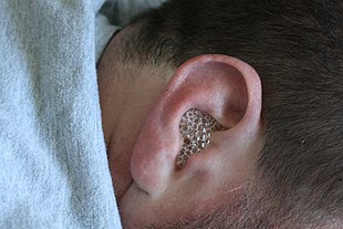 Cerumenolytic used in right ear.jpg