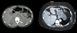 Two computed tomography images of a horizontal section of the mid abdominal region; one from a normal weight individual the other from an obese person. In both the bony structures and organs appear similar. The primary difference is that in the normal weight person there is little subcutaneous fat and the obese person shows substantially subcutaneous fat.