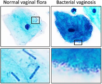 Normal vaginal flora versus bacterial vaginosis on Pap stain.jpg