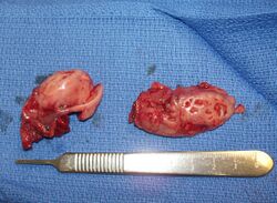 Pair of Removed Tonsils.JPG