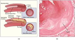 2113ab Atherosclerosis.jpg