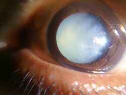 Dense white mature cataract.jpg