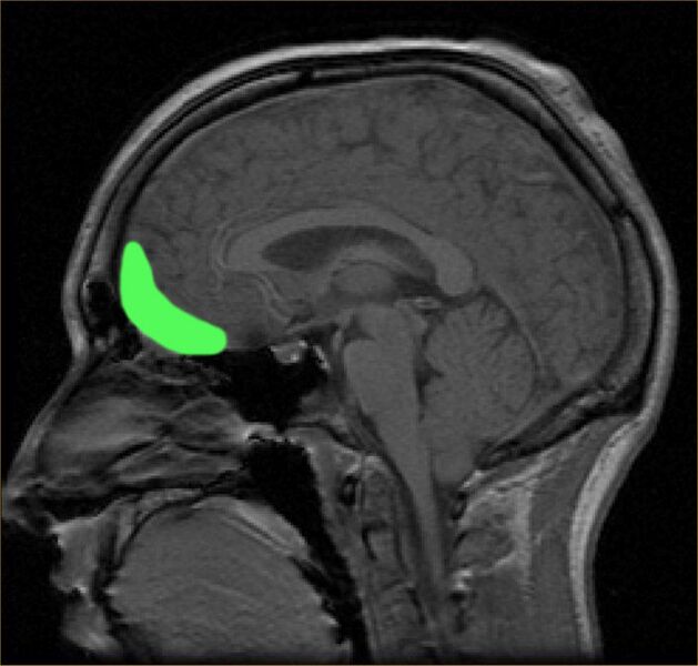 File:MRI of orbitofrontal cortex.jpg