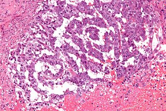 Mixed germ cell tumour - high mag.jpg