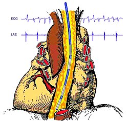 Simultane transösophageale elektrokardiographische Ableitung des linken Vorhofes und der linken Herzkammer.jpg
