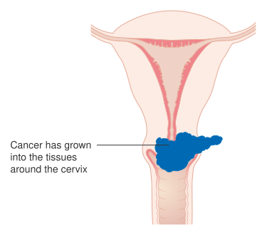 File:Diagram showing stage 2B cervical cancer CRUK 216.svg