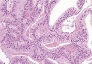 Micrograph of typical ductal adenocarcinoma of the prostate.jpg