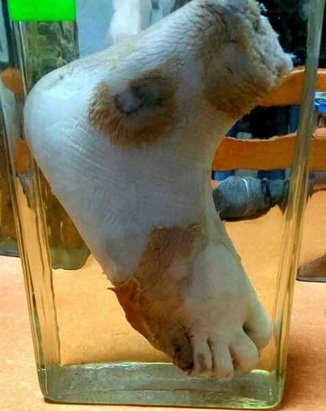 File:Wet gangrene of the foot.jpg