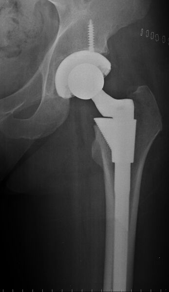 File:Hip-replacement.jpg