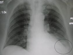 LLL pneumonia with effusionM.jpg