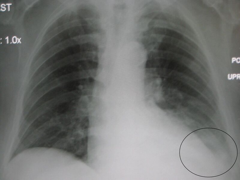 File:LLL pneumonia with effusionM.jpg