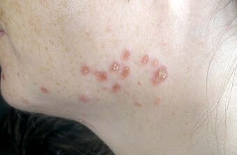 Cutaneous findings in systemic sarcoidosis.JPEG