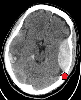 EpiduralHematoma.jpg